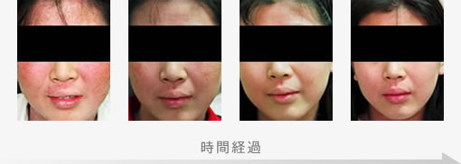 アトピー性皮膚炎の症状改善例5 症例写真