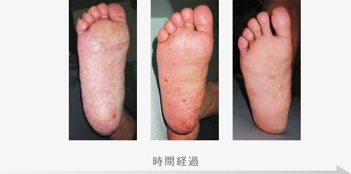 掌蹠膿疱症の症状改善例1 症例写真