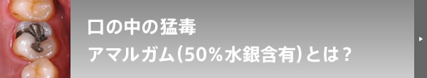 口の中の猛毒 アマルガム（50%水銀含有）とは？