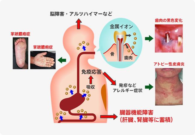 金属イオンとして溶解して、体内に吸収されるイメージ