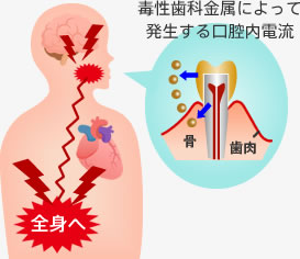 毒性歯科金属によって発生する口腔内電流