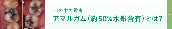 口の中の猛毒 アマルガム（約50%水銀含有）とは？