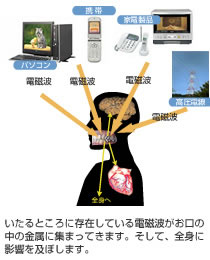 いたるところに存在している電磁波がお口の中の金属に集まってきます。そして、全身に影響を及ぼします。