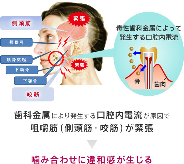 歯科金属により発生する口腔内電流が原因で咀嚼筋（側頭筋・咬筋）が緊張することで噛み合わせに違和感が生じる