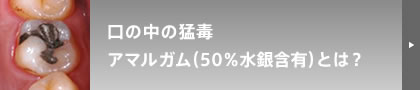 口の中の猛毒 アマルガム（50％水銀含有）とは？