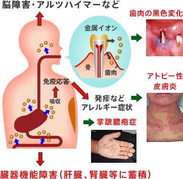 体内に金属イオンが流出・吸収される仕組み