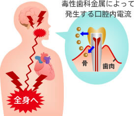 毒性歯科金属によって発生する口腔内電流