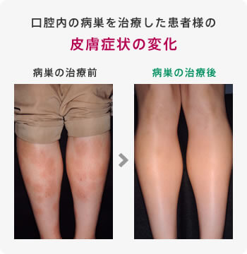 口腔内の病巣を治療した患者様の皮膚症状の変化