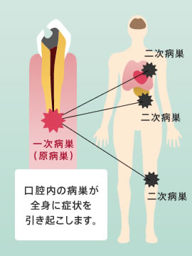 口腔内の病巣が全身に症状を引き起こします。