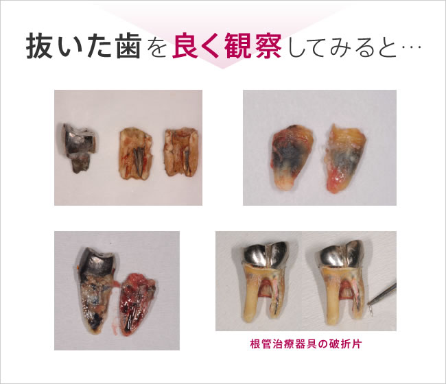 抜いた歯を良く観察してみると…