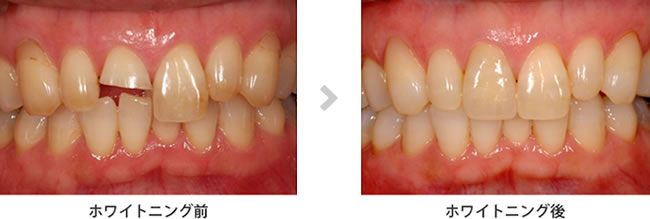 ホワイトニング前後