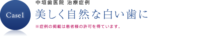 美しく自然な白い歯に