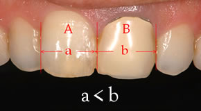 治療前の前歯の幅径
