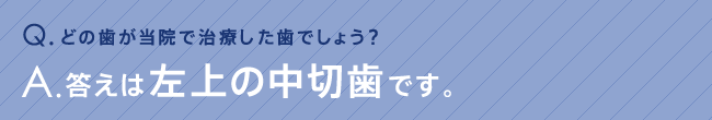 どの歯が当院で治療した歯でしょう？答えは左上の中切歯です。