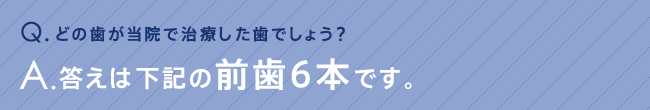 どの歯が当院で治療した歯でしょう？答えは下記の前歯2本です。