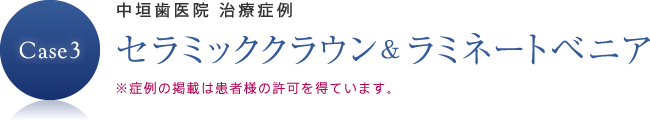 セラミッククラウン＆ラミネートベニア