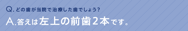 どの歯が当院で治療した歯でしょう？答えは左上の前歯2本です。