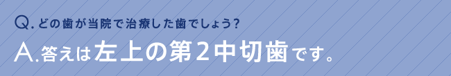 どの歯が当院で治療した歯でしょう？答えは左上の第2中切歯です。