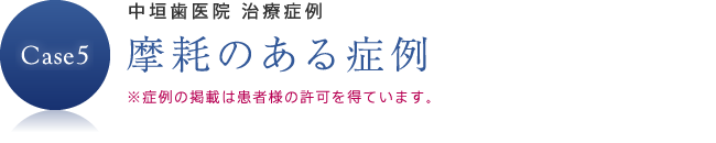 摩耗のある症例