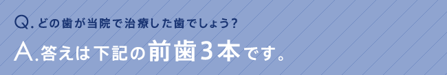 どの歯が当院で治療した歯でしょう？答えは下記の前歯3本です。