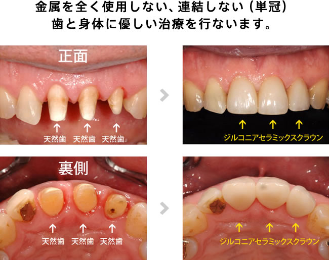 金属を全く使用しない、連結しない（単冠）歯と身体に優しい治療を行ないます。