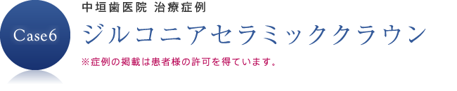 ジルコニアセラミッククラウン