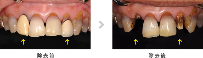 差し歯の除去前後の正面写真