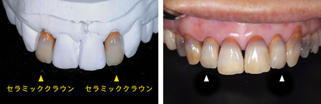 制作された技工