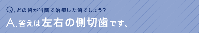 どの歯が当院で治療した歯でしょう？答えは左右の側切歯です。