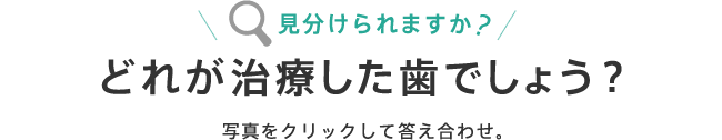 見分けられますか？どれが治療した歯でしょう？写真をクリックして答え合わせ。