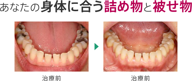 あなたの身体に合う詰め物と被せ物