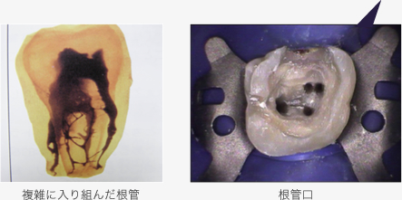 根管は複雑に入り組んでいます