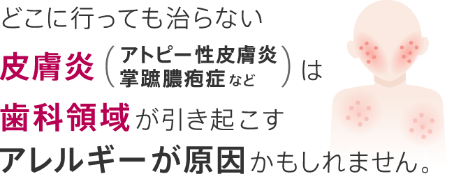 どこに行っても治らない皮膚炎（アトピー性皮膚炎・掌蹠膿疱症など）は歯科領域が引き起こすアレルギーが原因かもしれません。