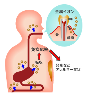 体内で金属イオンが溶解する流れ