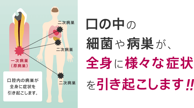 口の中の細菌や病巣が、全身に様々な症状を引き起こします！！