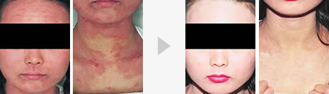 アトピー性皮膚炎の症状改善例1 症例写真