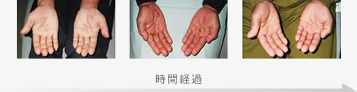 掌蹠膿疱症の症状改善 症例写真