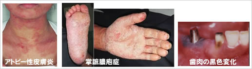 症例写真「アトピー性皮膚炎」「掌蹠膿疱症」「歯肉の黒色変化」