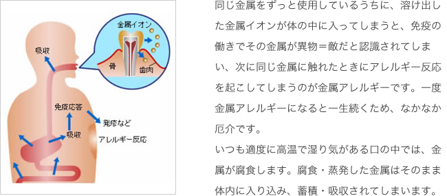 同じ金属をずっと使用しているうちに、溶け出した金属イオンが体の中に入ってしまうと、免疫の働きでその金属が異物＝敵だと認識されてしまい、次に同じ金属に触れたときにアレルギー反応を起こしてしまうのが金属アレルギーです。