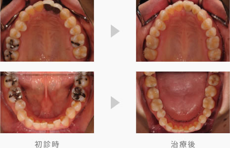 不適合歯科金属を除去した症例写真