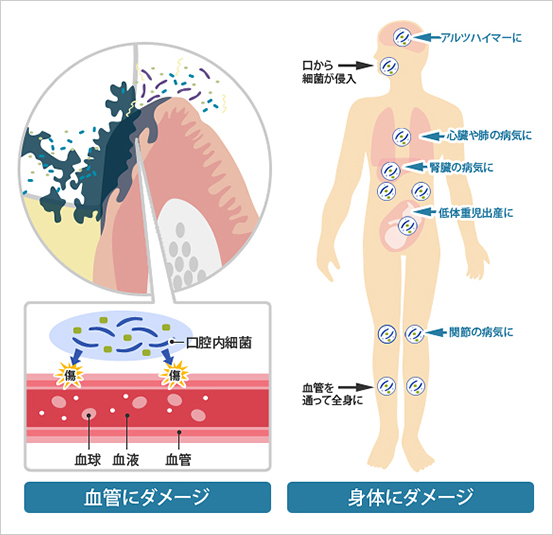 口腔内細菌が血管から身体を巡る流れ