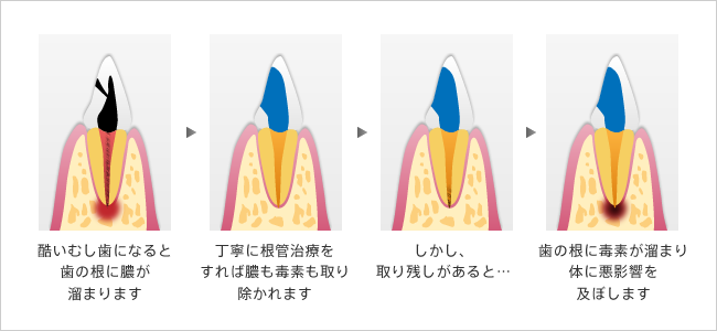 歯の根の取り残された膿や毒素は、再び身体に害を及ぼします
