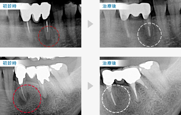 根管治療前後の歯質をレントゲンで確認