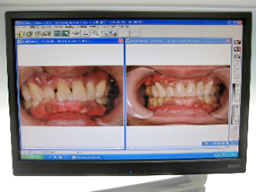口腔内写真での比較