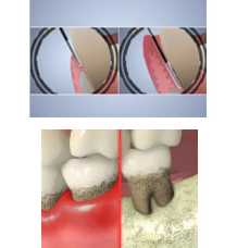 歯周病組織精密検査
