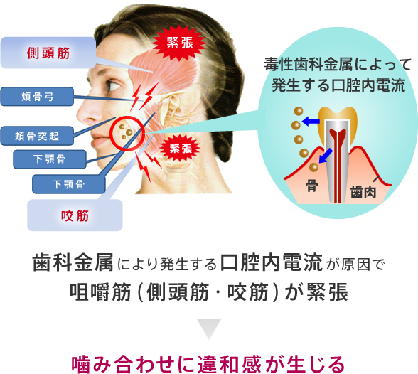 歯科金属により発生する口腔内電流が原因で咀嚼筋（側頭筋・咬筋）が緊張することで噛み合わせに違和感が生じる