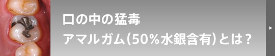 口の中の猛毒 アマルガム（50%水銀含有）とは？