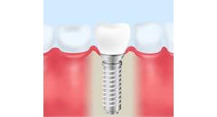 一般的なチタンのインプラント