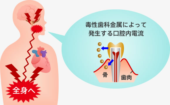 毒性歯科金属によって発生する口腔内電流