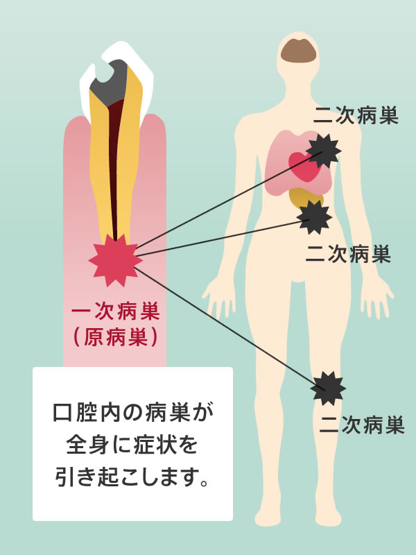 口腔内の病巣が全身に症状を引き起こします